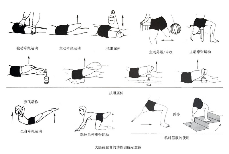截肢者的康复治疗